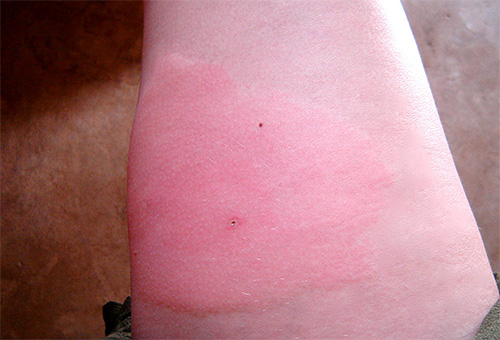 La piqûre de guêpe provoque un gonflement et des démangeaisons dans la zone touchée