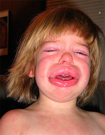 Œdème de Quincke chez un enfant