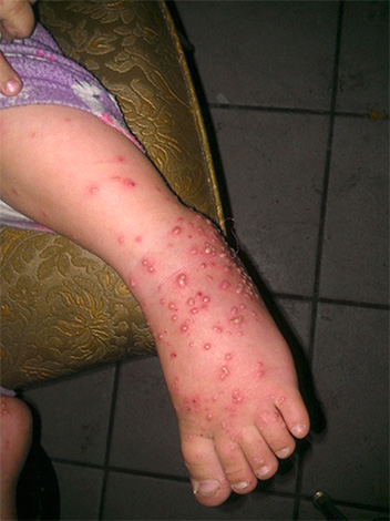 Pustules sur la jambe d'un enfant