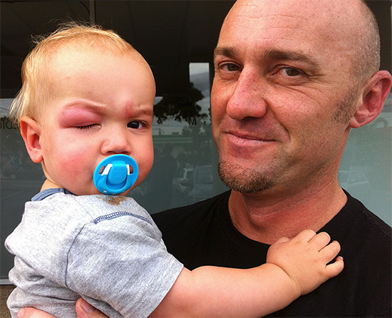 Les taches rouges après les piqûres d'insectes chez les enfants peuvent persister plusieurs jours.