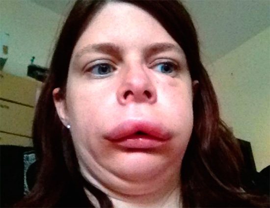 Avec l'œdème de Quincke, les voies respiratoires peuvent parfois se chevaucher, ce qui crée une menace directe pour la vie humaine.