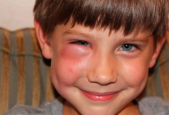 En règle générale, avec une morsure de frelon, aucun traitement spécial n'est requis et les conséquences disparaissent d'elles-mêmes en quelques jours.