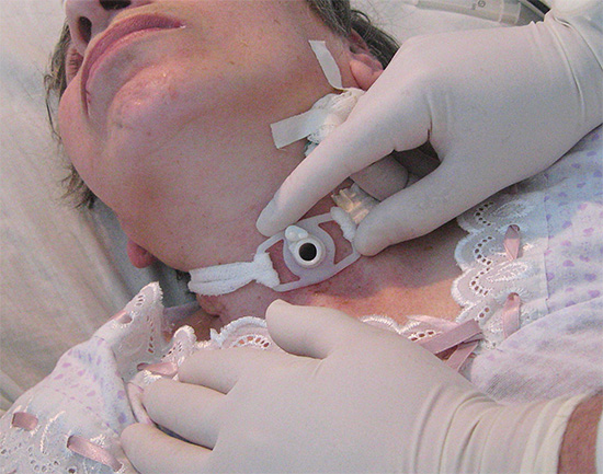 En cas de gonflement sévère du larynx, une conicotomie peut être nécessaire.