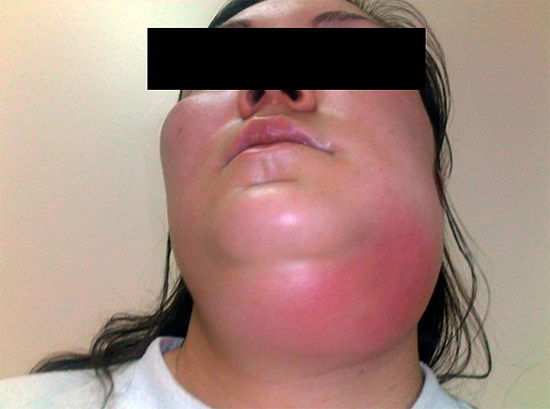 Une piqûre de frelon dans la région de la gorge est très dangereuse, car les voies respiratoires peuvent être bloquées en raison d'un œdème.