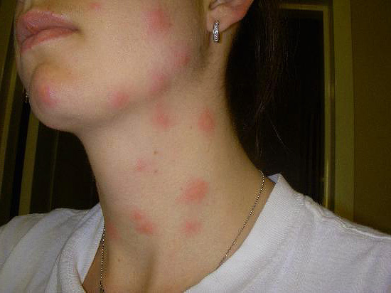 Les piqûres de punaises de lit affectent le plus souvent les parties du corps qui ne sont pas protégées par les vêtements et les sous-vêtements - le cou, les épaules et les bras.