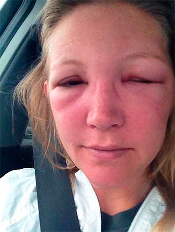 Avec une sensibilité élevée d'une personne au poison des insectes hyménoptères, des réactions allergiques très graves et dangereuses peuvent être observées.