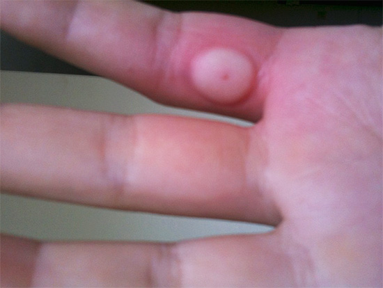 Dans la première minute après la morsure, l'aspiration du poison de la plaie peut avoir un certain effet positif.