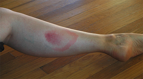 Quelque chose comme cela peut ressembler à une marque de morsure de frelon quelques jours plus tard, lorsque le gonflement a déjà diminué.