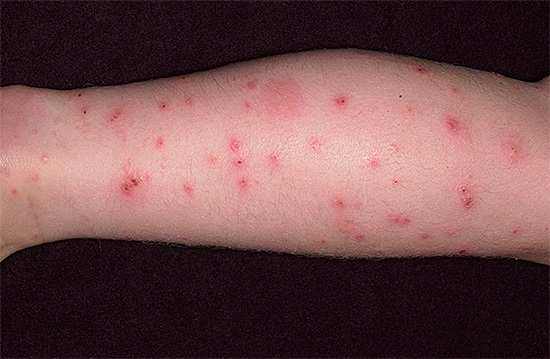 Voici à quoi ressemblent les piqûres de puces