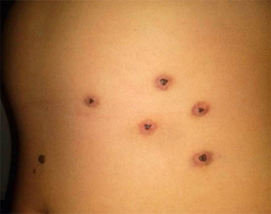 Voici à quoi ressemblent les marques de morsure de sangsue sur le corps.