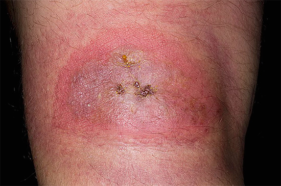 Marque de morsure d'araignée tarentule