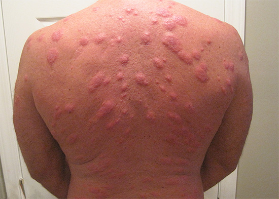 Avec un grand nombre de punaises de lit dans la maison, leurs piqûres sur le corps peuvent être très nombreuses...