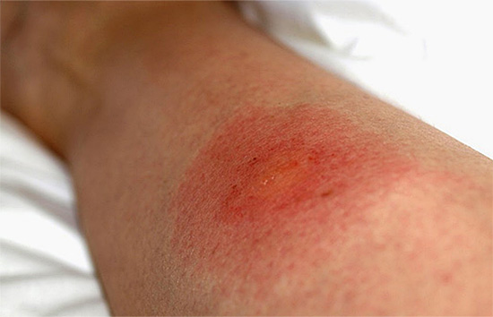 Au fil du temps, la taille du site de la morsure peut augmenter considérablement et parfois le gonflement s'étend à tout le membre - un bras ou une jambe.