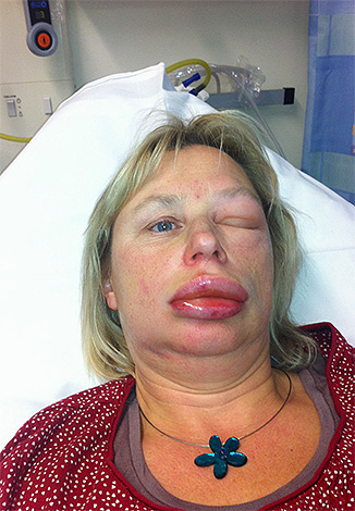 L'œdème de Quincke est une manifestation plutôt dangereuse d'une réaction allergique.