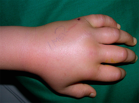 Lorsqu'elle est mordue par des insectes piqueurs, la main peut tellement gonfler qu'il est presque impossible de serrer les doigts dans un poing.