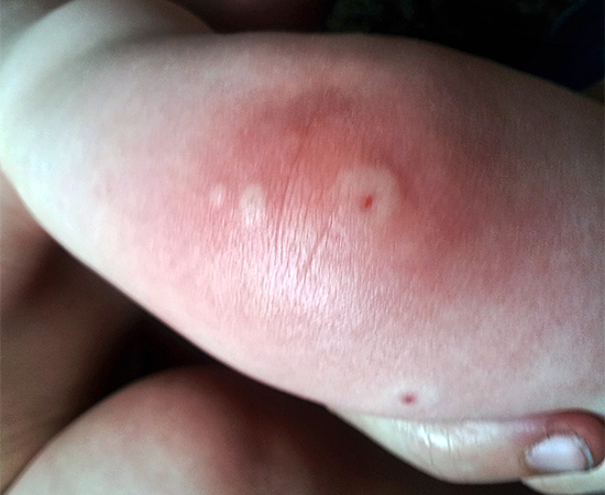 Un léger gonflement et un gonflement des tissus sont généralement une réaction normale du corps humain aux piqûres d'une grande variété d'insectes.