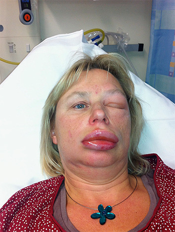 Avec les piqûres d'insectes, les tissus enflés peuvent réduire la perméabilité des voies respiratoires, ce qui crée une réelle menace d'étouffement, lorsqu'une issue fatale n'est pas exclue.