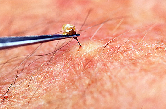 La piqûre laissée dans la peau doit être retirée le plus rapidement possible afin que de nouvelles portions de poison ne pénètrent pas dans la plaie.