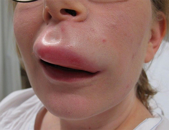 Dans certains cas, une piqûre de guêpe peut devenir mortelle en raison du blocage des voies respiratoires (par exemple, l'œdème de Quincke).