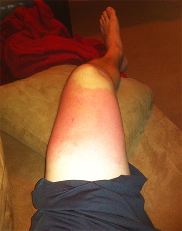 Pour les personnes allergiques aux piqûres d'hyménoptères, le venin de guêpe et d'abeille peut être très dangereux.