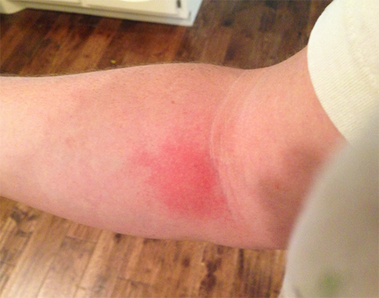 Il est préférable de ne pas gratter la zone touchée afin que le gonflement n'augmente pas.