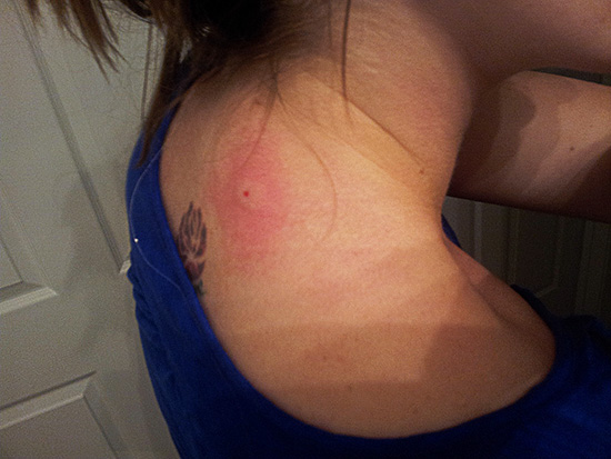 Une réaction allergique aux piqûres de guêpes peut se présenter comme une inflammation inoffensive, et peut prendre des formes beaucoup plus dangereuses.