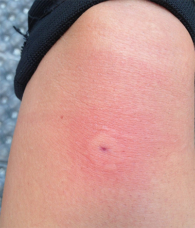 La photo montre une piqûre de guêpe fraîche - le gonflement vient de commencer à se former.