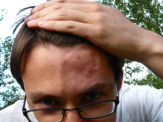 Piqûre de guêpe sur la tête