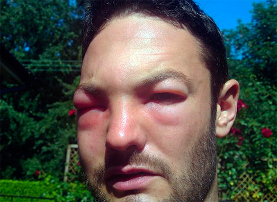 Les piqûres de guêpes au visage peuvent non seulement entraîner la fermeture des deux yeux, mais peuvent en général constituer un danger accru pour la vie humaine.