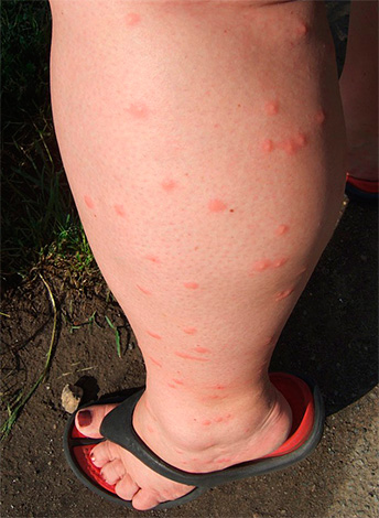 Petits points rouges sur la jambe - nombreuses piqûres de puces.