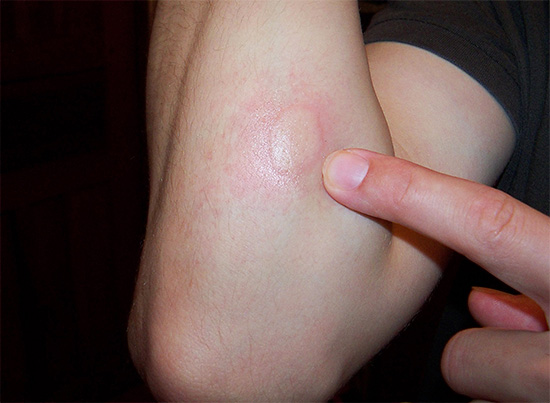 Habituellement, les piqûres de petits insectes suceurs de sang ne nécessitent aucun traitement particulier et disparaissent rapidement d'elles-mêmes.