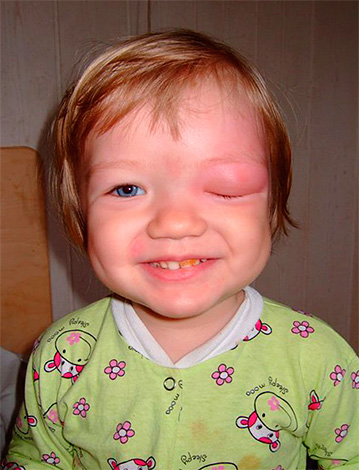 Après le traitement, il est utile de distraire l'enfant de la douleur et des démangeaisons avec un jeu passionnant.