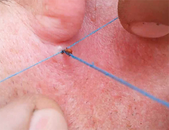 Vous pouvez également supprimer une tique avec un fil ...