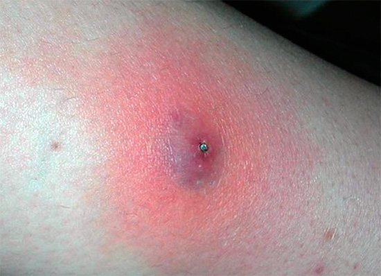 Morsure d'araignée venimeuse