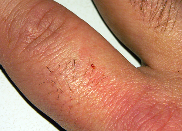 Les larves de punaises de lit se nourrissent de sang.