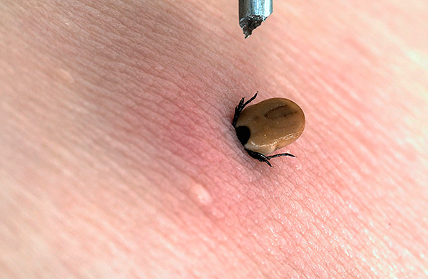 Le simple fait d'arracher une tique mordante par la force n'a aucun sens et est même dangereux.