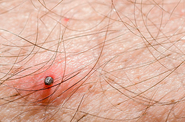 La photo montre une tique qui s'est enfoncée dans la peau - son appareil buccal a littéralement plongé profondément dans les tissus mous.