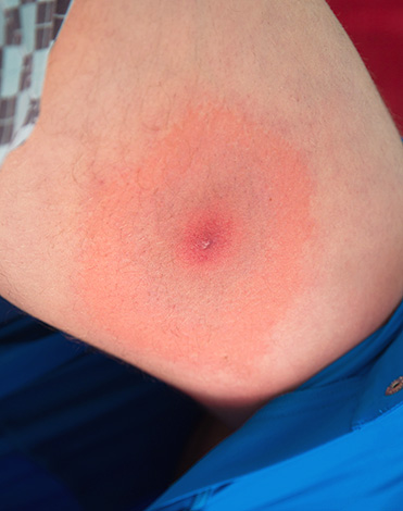 Voici à quoi ressemble généralement une piqûre de tique borréliose.