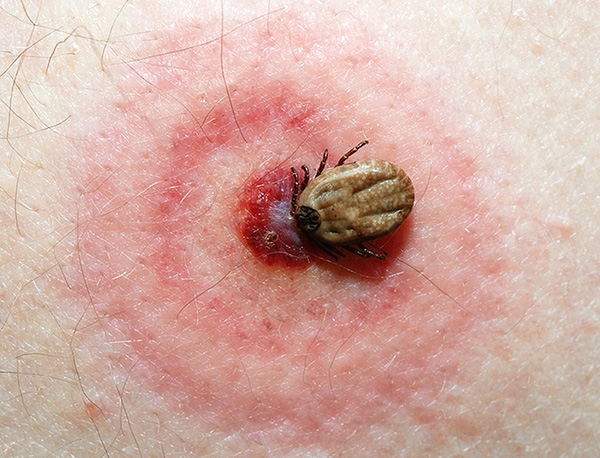 Voici des nuances importantes qu'il est utile de connaître en cas de morsure par une tique de la borréliose ...