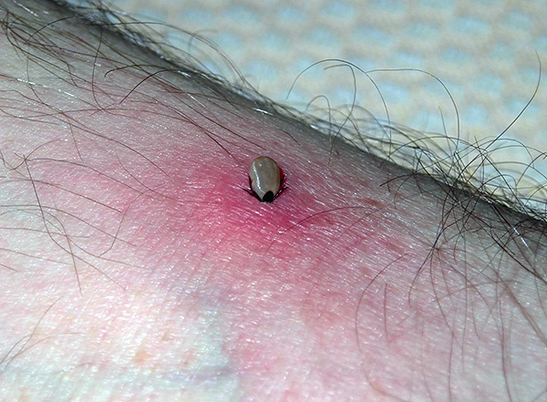 Les bactéries pénètrent dans la plaie avec la salive du parasite, et en plus grand nombre, plus la morsure dure longtemps.