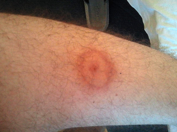 Au début, seule une tache de morsure est observée (il n'y a pas de températures et d'autres symptômes généraux).