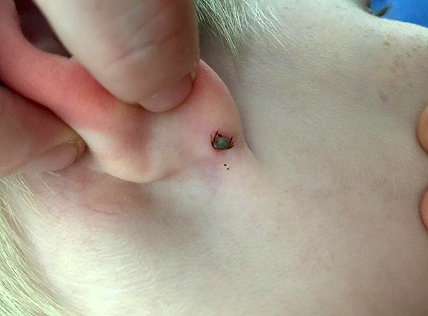 La tique a mordu dans l'oreille de l'enfant.