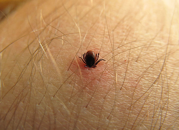 Tique de chien sur le corps humain