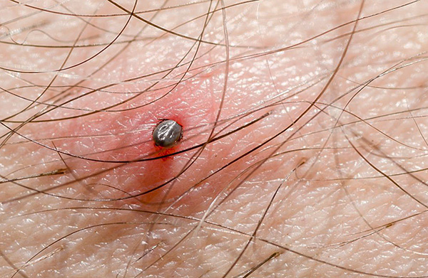 Voyons exactement comment une tique mord ...