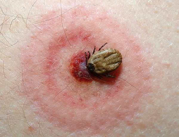 Dans certains cas, le parasitisme des tiques entraîne le développement de maladies infectieuses graves chez l'homme et l'animal (encéphalite à tiques, borréliose, etc.)