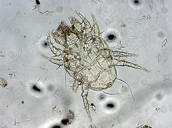 Démangeaison de la gale (Sarcoptes scabiei) 