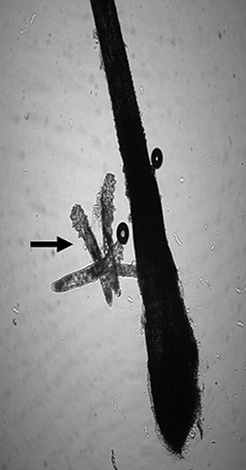 Glandes d'acné dans la région du follicule pileux.