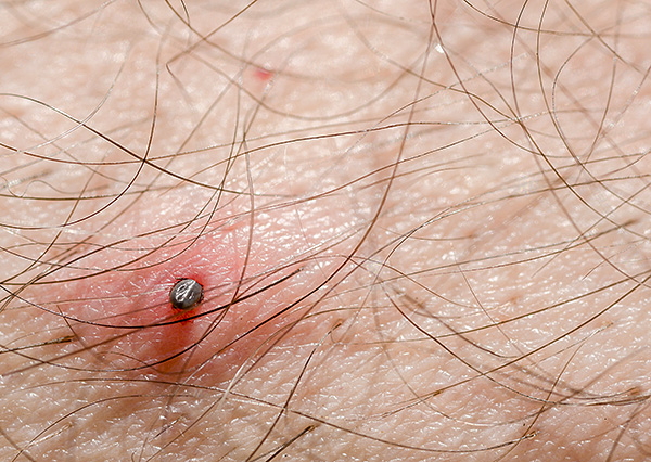 Plus longtemps le parasite suce du sang, plus il injecte de salive infectée dans la plaie.