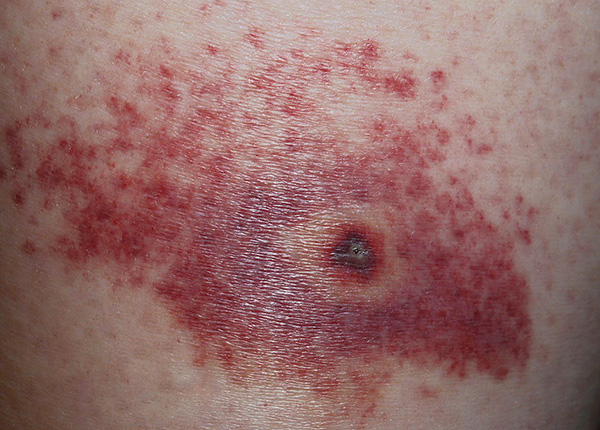 Le traitement antiseptique du site de la morsure ne protégera pas contre l'encéphalite à tiques ou la borréliose, mais réduira le risque d'infection secondaire.