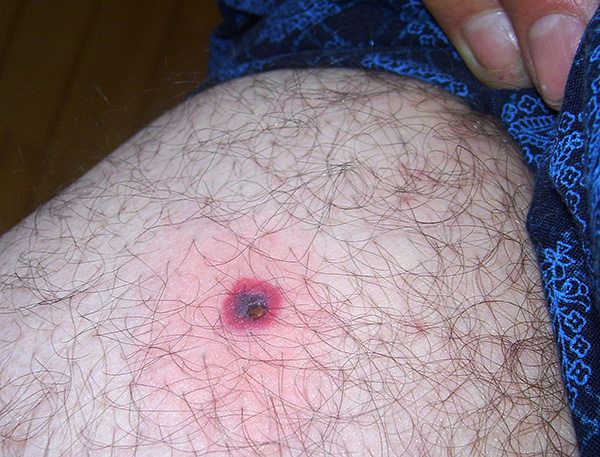 Les tiques ixodides sont porteuses de maladies humaines dangereuses telles que l'encéphalite à tiques et la maladie de Lyme (borréliose).